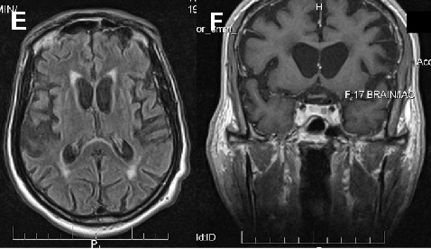 Neuroacanthocytosis encompasses multiple genetic subtypes with overlapping clinical features. This figure provides additional clinical, pathological, or molecular data supporting the differential diagnosis of these rare movement disorders.