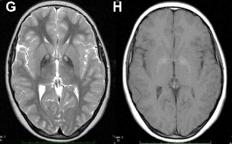 Neuroacanthocytosis encompasses multiple genetic subtypes with overlapping clinical features. This figure provides additional clinical, pathological, or molecular data supporting the differential diagnosis of these rare movement disorders.