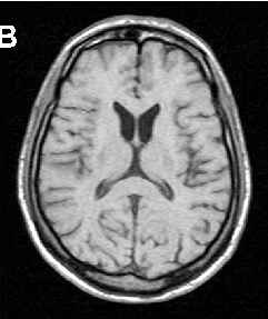Brain imaging in neuroacanthocytosis typically reveals caudate nucleus atrophy and putaminal changes. This figure presents structural neuroimaging findings characteristic of advanced basal ganglia degeneration in NA patients.