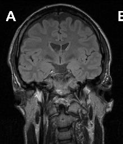 Brain imaging in neuroacanthocytosis typically reveals caudate nucleus atrophy and putaminal changes. This figure presents structural neuroimaging findings characteristic of advanced basal ganglia degeneration in NA patients.