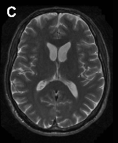 Neuroacanthocytosis encompasses multiple genetic subtypes with overlapping clinical features. This figure provides additional clinical, pathological, or molecular data supporting the differential diagnosis of these rare movement disorders.