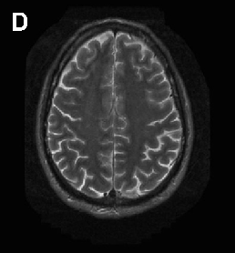 Brain imaging in neuroacanthocytosis typically reveals caudate nucleus atrophy and putaminal changes. This figure presents structural neuroimaging findings characteristic of advanced basal ganglia degeneration in NA patients.