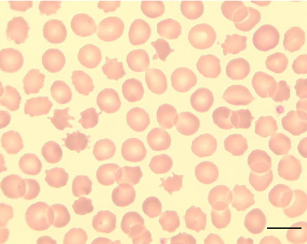 Peripheral blood smear from a patient with McLeod syndrome reveals acanthocytosis, characterized by irregularly spiculated red blood cells. May Gruenwald-Giemsa staining at 100x magnification (scale bar = 10 micrometers) highlights the distinctive thorny morphology of these erythrocytes.