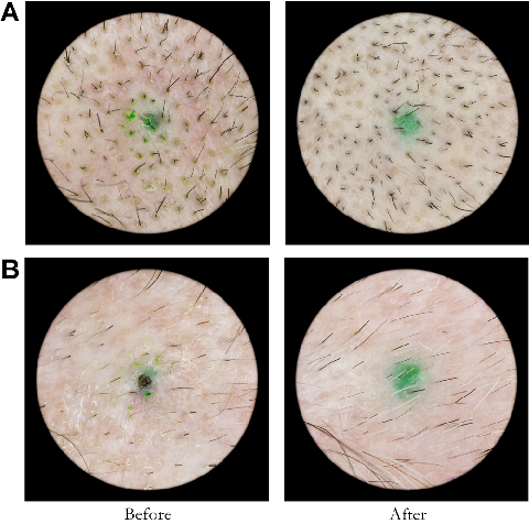 Fig. 1. Sham treatment group subject pre and post treatment image examples. Hair counts for subject A were 151 at baseline and 166 post treatment. Hair counts for subject B were 41 at baseline and 44 post treatment.