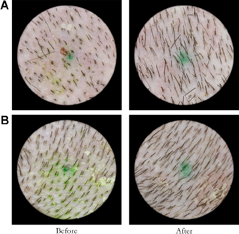 Fig. 2. Active treatment group subject pre and post treatment image examples. Hair counts for subject A were 153 at baseline and 221 post treatment. Hair counts for subject B were 108 at baseline and 209 post treatment.