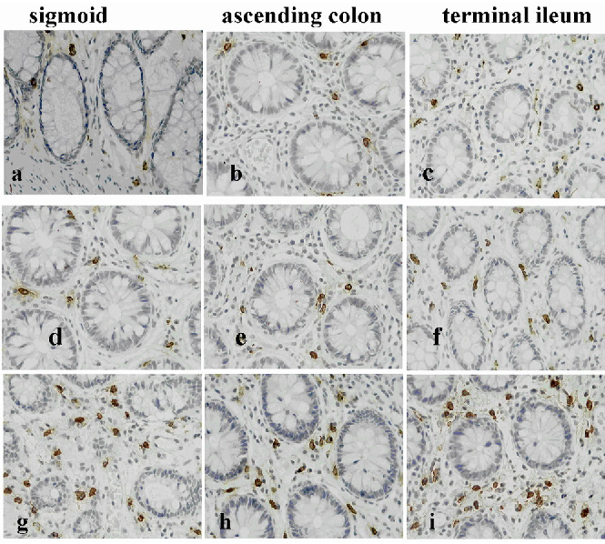 Figure 4. Representative photomicrographs showing tryptase positive mast cells (MCs) in the colonic mucosa of a healthy control (HCs) (a–c); an diarrhea predominant irritable bowel syndrome (IBS-D) patient with lactose malabsorption (LM) (d–f) and a patie