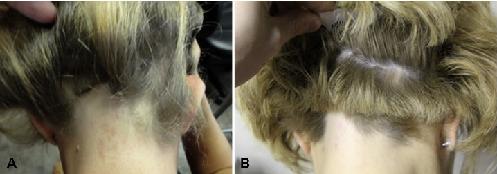 Fig 1. Hair regrowth in ophiasis-type alopecia areata after platelet-rich plasma (PRP) injection. Occipital hair loss before treatment (A) and occipital hair regrowth 3 months after administration of PRP at a concentration 3.5 times above baseline (B).
