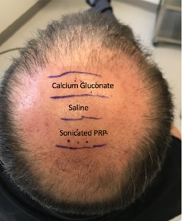 Figure 3 Location of the PL, AA-PRP, and saline treatment zones for Subject C. Forty grafts were placed in each box, and hair checks were conducted 14 weeks post-surgery. PL, platelet lysate; AA– PRP, autologous activated platelet rich plasma.