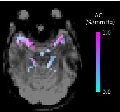 An arterial compliance map shows the percentage change in arterial blood volume per millimeter of mercury, obtained using short inversion time arterial spin labeling to assess cerebrovascular reactivity.
