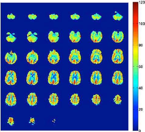 An arterial spin labeling cerebral blood flow map displays regional perfusion in units of milliliters per 100 grams of brain tissue per minute, illustrating the spatial distribution of blood flow across cortical regions.