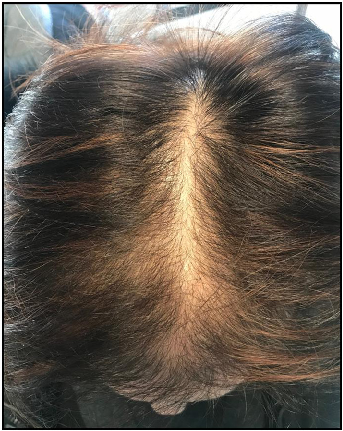Fig. 1. Clinical example of female pattern hair loss
