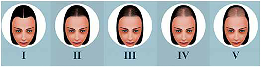 Fig. 3. Sinclair Scale Sinclair’s classiﬁcation. MPA is divided into four levels of intensity on the basis of normal scalp to the left (Sinclair et al., 2005).