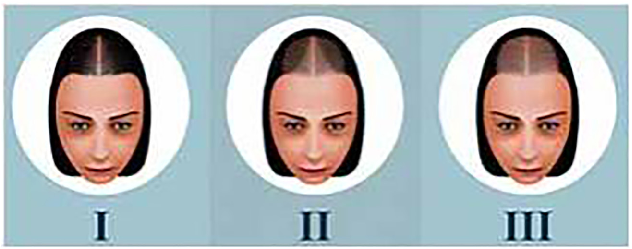 Fig. 4. Olsen´s classiﬁcation. Olsen patterns incorporate the accentuation of the front-overtical alopecia, which has a triangular or Christmas tree form with hair loss in a triangular form in the front-overtical area (Olsen, 2002).