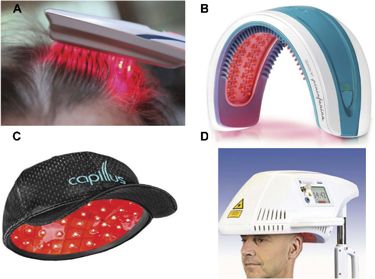 Figure 2 Examples of PBM devices for alopecia. (A) HairMax LaserComb (Lexington Int, Boca Raton, FL); (B) HairMax LaserBand 82 (Lexington); (C) RedRestore Max Laser Cap 272 (Capillus, Miami, FL); (D) Revage 670 Laser Hood (Apira Science, Boca Raton, FL).