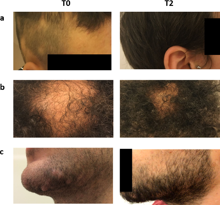Fig. 3 Digital photographs from three different subjects (a, b, c). Baseline (T0), 3 months of treatment (T2)