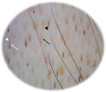 Fig. 1 Representative dermoscopic image from enrolled subjects at baseline showing yellow dots (black arrow), black dots (black triangle), dystrophic hairs (white arrow) and exclamation mark (white triangle)