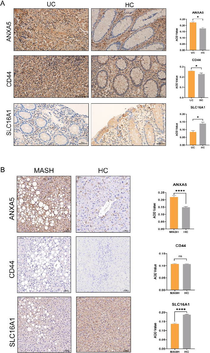 Drug sensitivity or molecular docking analysis targeting butyrate metabolism-related genes shared between MASLD and colorectal cancer.